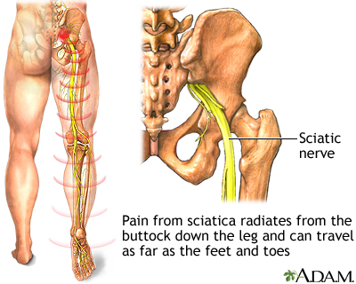 What Is The Best Treatment For Sciatica Instantly?